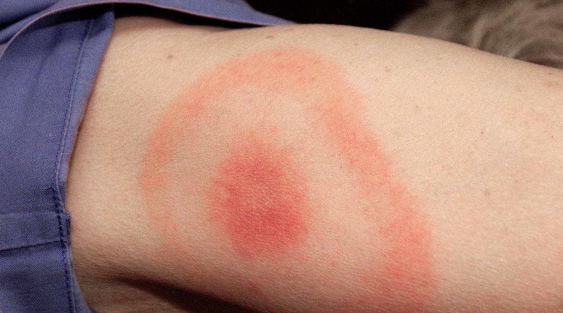 The typical bull's-eye rash often seen in Lyme disease is caused by the dynamics of the fight that ensues between the body's immune cells and the bacteria.
